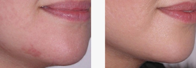 Apolomed Spectra 6 9